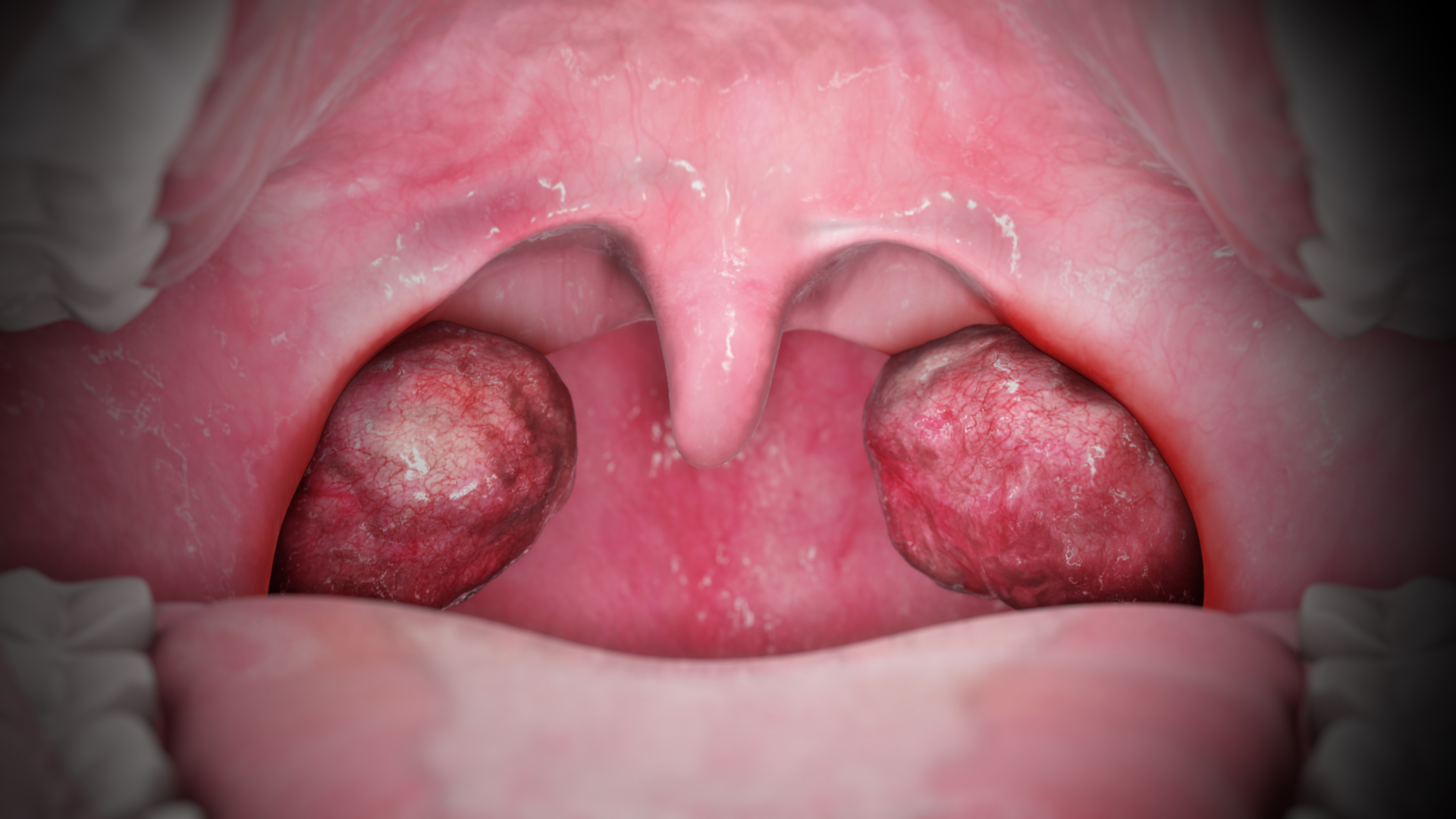 Acute-Tonsillitis
