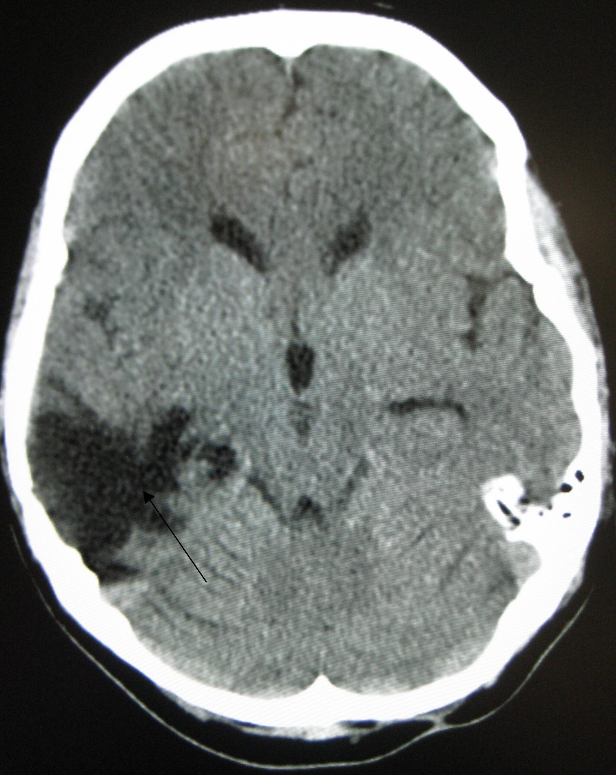 Traumatic Brain Injury Scan